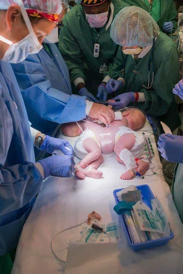 Doctors treating the conjoined twins