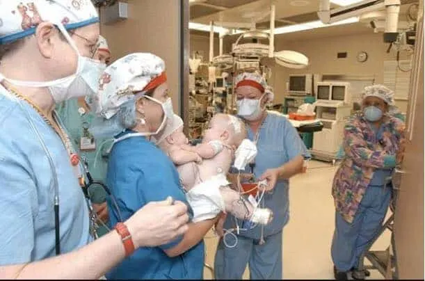 The conjoined twins with a team of medical staff.