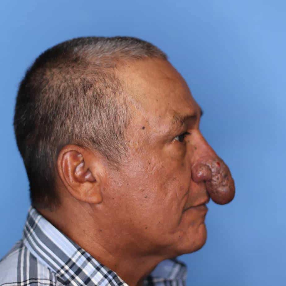 Conrado Ramos Estrada with rhinophyma