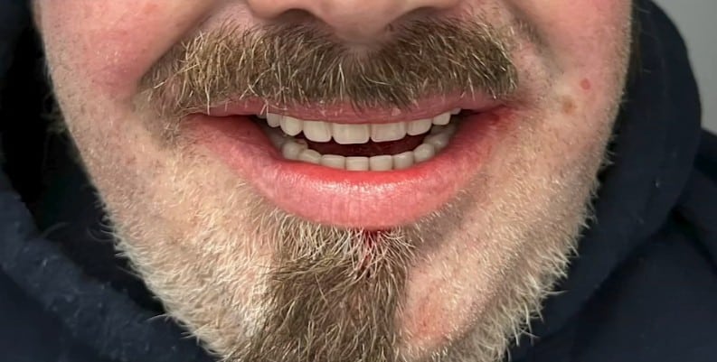 Gregory Cuta's new set of teeth