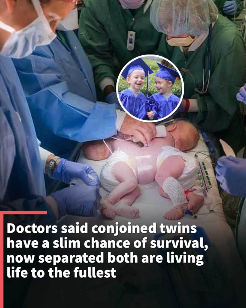 Doctors said conjoined twins have a slim chance of survival, now separated both are living life to the fullest