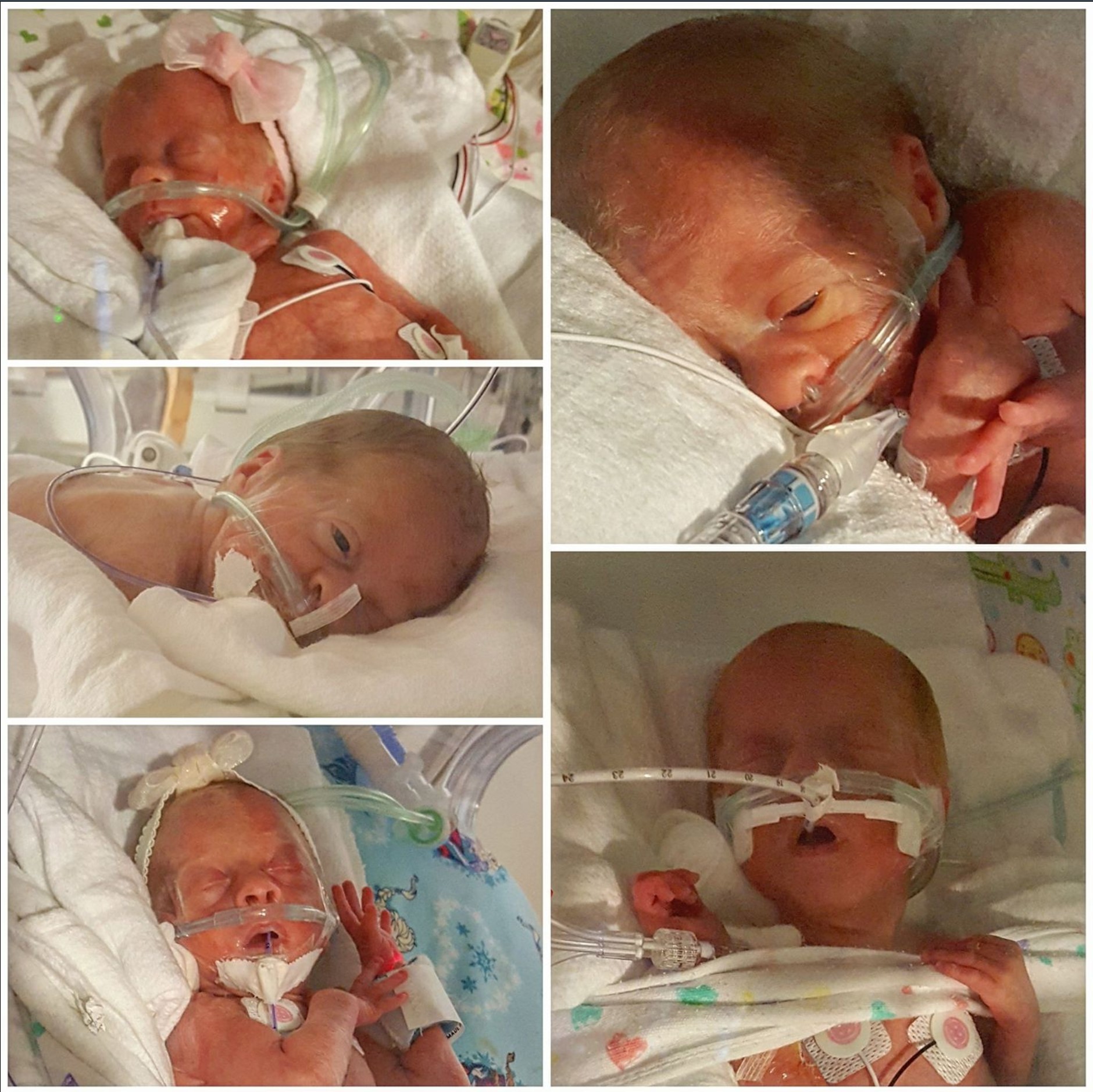 Driskell quintuplets at neonatal intensive care unit at birth.
